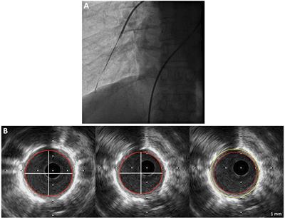 Pulmonary Arterial Remodeling Is Related to the Risk Stratification and Right Ventricular-Pulmonary Arterial Coupling in Patients With Pulmonary Arterial Hypertension